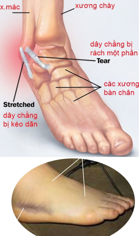 Những sai lầm trong việc chữa trị bong gân