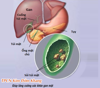 Sỏi túi mật