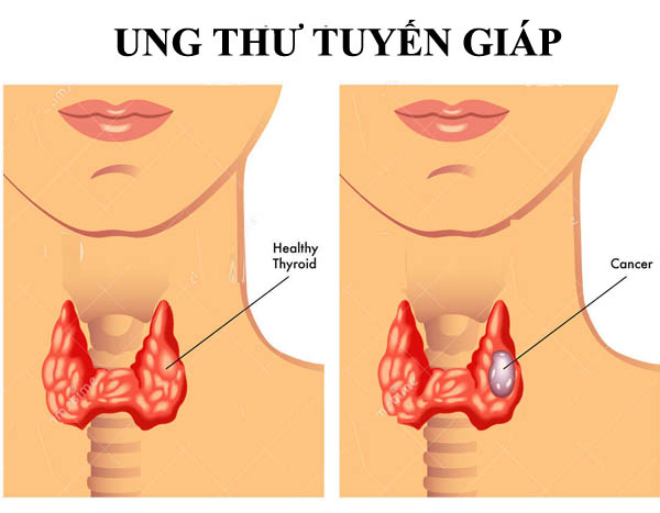 Các triệu chứng lâm sàng ung thư tuyến giáp