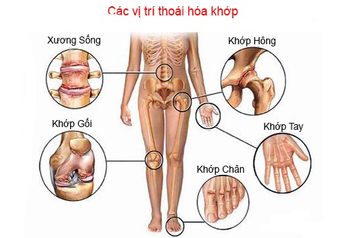 Những hiểu biết về thoái hóa khớp
