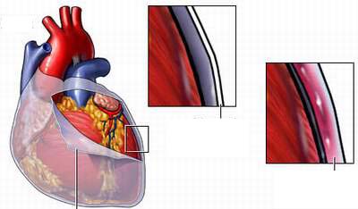 Hiểu biết về viêm ngoại tâm mạc