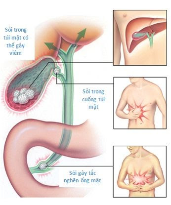 Nguyên nhân và triệu chứng của viêm túi mật