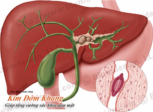 Bệnh viêm mủ đường mật