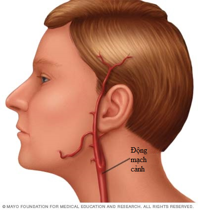 Hẹp động mạch cảnh - một trong các nguyên nhân gây nên tai biến mạch máu não