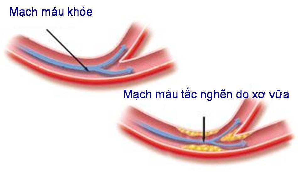 Chế độ ăn uống kiêng kị cho bệnh nhân Xơ vữa động mạch