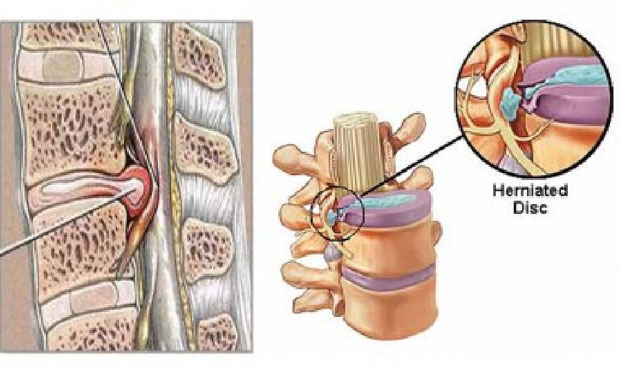 Tổng quát về bệnh thoát vị đĩa đệm và phương pháp điều trị