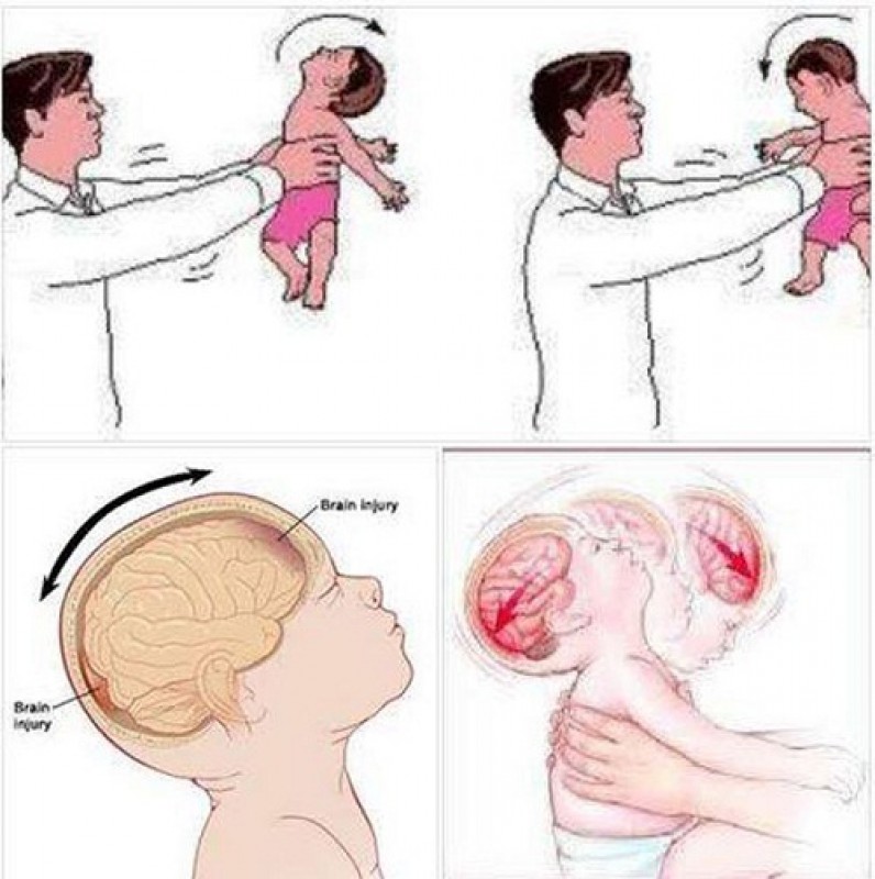 Đừng đung đưa trẻ mạnh vì sẽ gây tổn thương não trẻ
