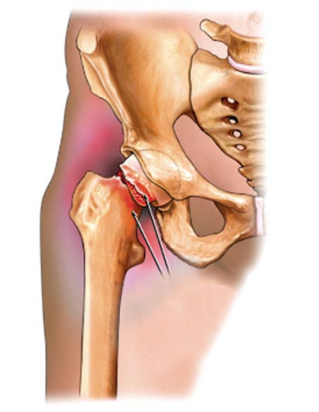 Những triệu chứng của bệnh thoái hóa khớp háng