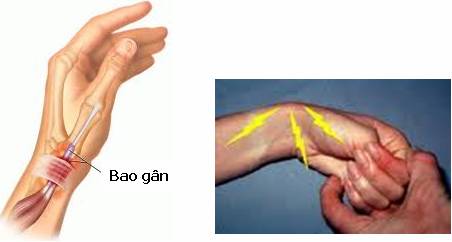 dinhduonghoc.com - viêm điểm bám gân