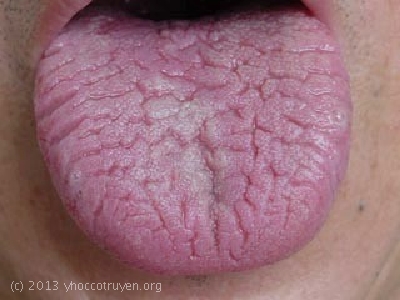 dinhduonghoc.com - benh ve luoi