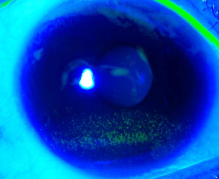 dinhduonghoc.com - hội chứng khô mắt