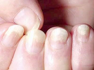 dinhduonghoc.com - 11 hiện tượng của móng tay ảnh hưởng tới sức khỏe