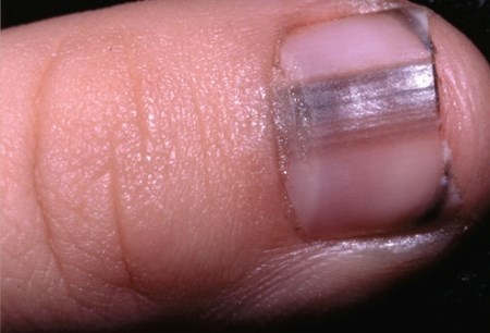 dinhduonghoc.com - 11 hiện tượng của móng tay ảnh hưởng tới sức khỏe