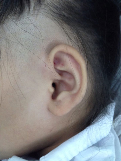 dinhduonghoc.com - bệnh rò luân nhĩ và những điều cần lưu ý
