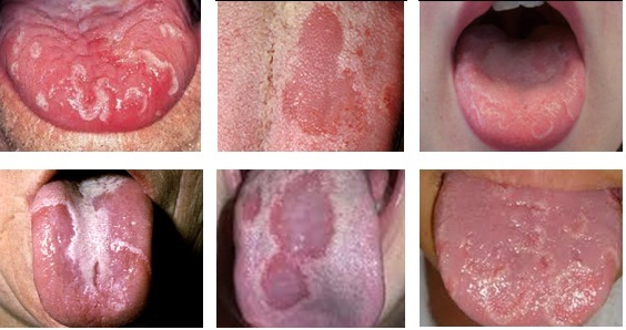 dinhduonghoc.com - Tưa lưỡi ở trẻ sơ sinh và cách chữa hiệu quả tại nhà