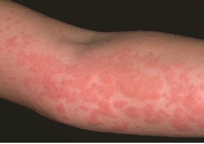 dinhduonghoc.com - 3 bài thuốc dân gian chữa mề đay