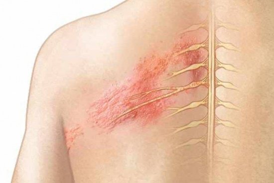 dinhduonghoc.com - cách đơn giản để chữa bệnh zona