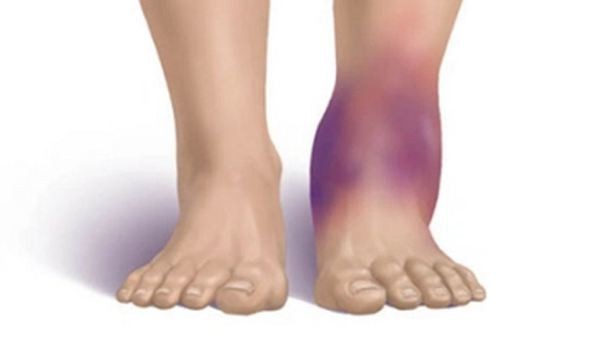 dinhduonghoc.com - 9 dấu hiệu của bệnh thận