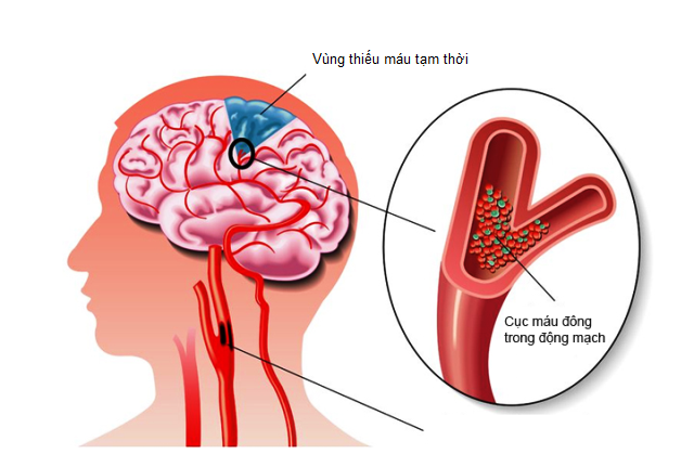 dinhduonghoc.com - Những nguyên nhân thiếu máu não theo từng độ tuổi