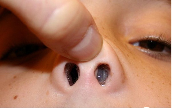 dinhduonghoc.com - Triệu chứng của polyp mũi, nguyên nhân và cách phòng ngừa