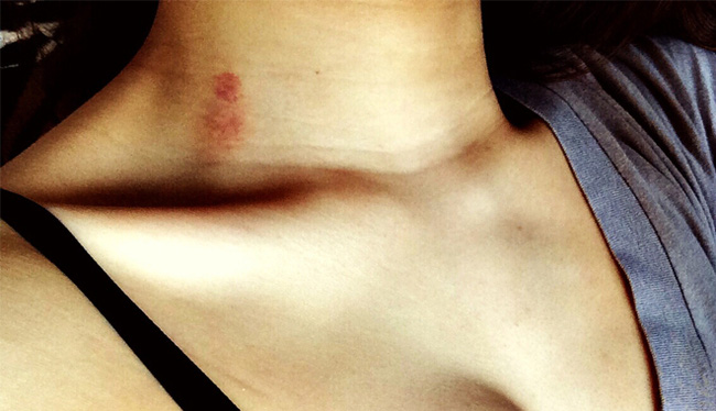 dinhduonghoc.com - Đừng xem thường những vết bầm đột nhiên xuất hiện trên da, bệnh nghiêm trọng đấy!