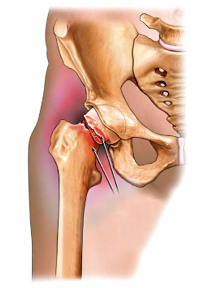 dinhduonghoc.com - Những triệu chứng của bệnh thoái hóa khớp háng