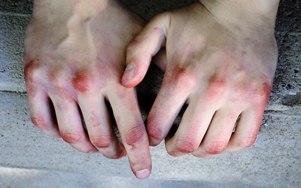 dinhduonghoc.com - Đừng xem thường những vết bầm đột nhiên xuất hiện trên da, bệnh nghiêm trọng đấy!