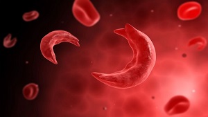 dinhduonghoc.com - Hồng huyết cầu: Sự nguy hiểm khi không còn là hình cầu!