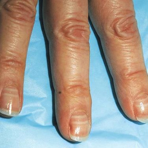 dinhduonghoc.com - 11 hiện tượng của móng tay ảnh hưởng tới sức khỏe