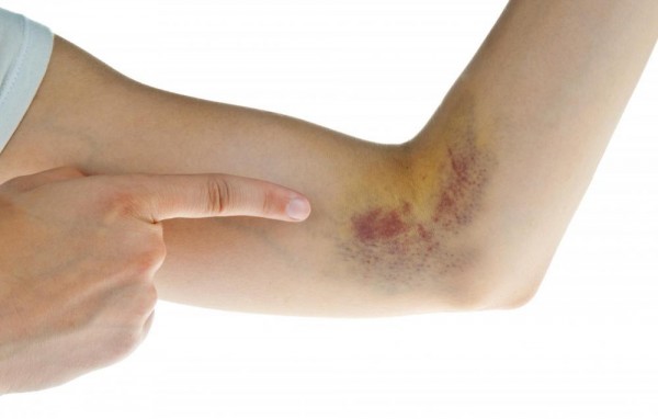 dinhduonghoc.com - Biểu hiện sớm của bệnh ung thư máu