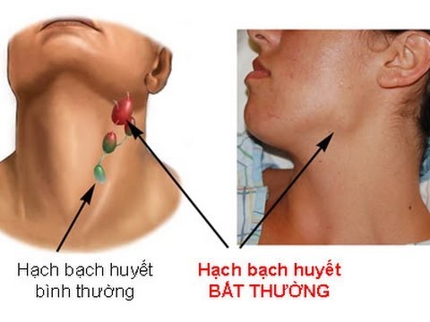dinhduonghoc.com - Biểu hiện sớm của bệnh ung thư máu