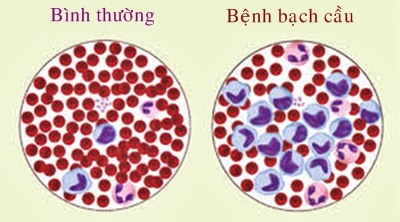 dinhduonghoc.com - Bệnh bạch cầu