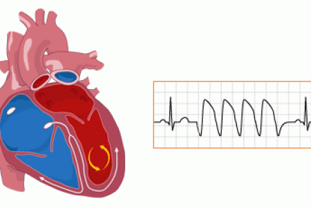 dinhduonghoc.com - Ngoại tâm thu thất nguy hiểm ra sao?
