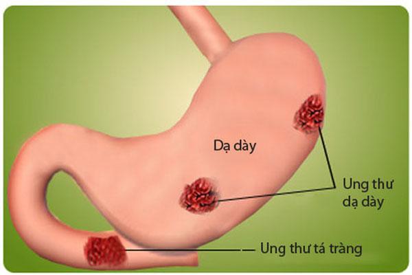 dinhduonghoc.com - Biến chứng nguy hiểm của bệnh viêm loét dạ dày