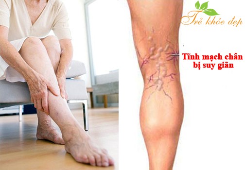 dinhduonghoc.com - Bệnh suy tĩnh mạch chi dưới - 80% người bệnh không biết