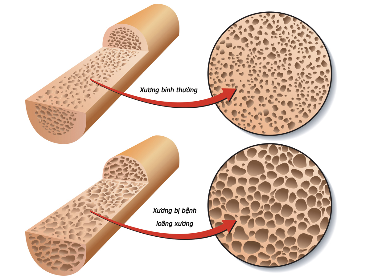 dinhduonghoc.com - Dinh dưỡng cho bệnh loãng xương