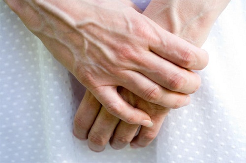 dinhduonghoc.com - Một vài phương pháp điều trị giãn tĩnh mạch tay