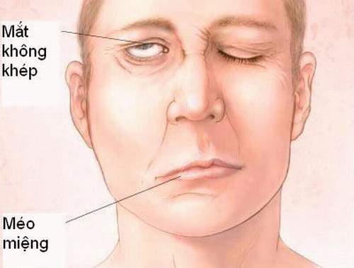 dinhduonghoc.com - liệt dây thần kinh số 7
