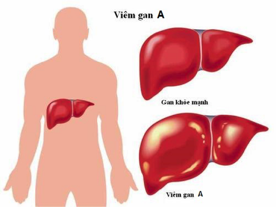 dinhduonghoc.com - Cách phòng bệnh và điều trị khi bị viêm gan siêu vi A
