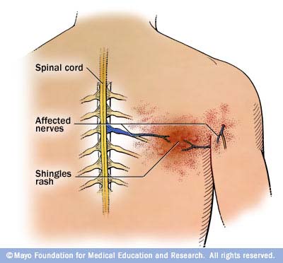 dinhduonghoc.com - Đau dây thần kinh sau herpes (Postherpetic) là gì?