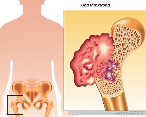 dinhduonghoc.com - Tổng quan ung thư xương