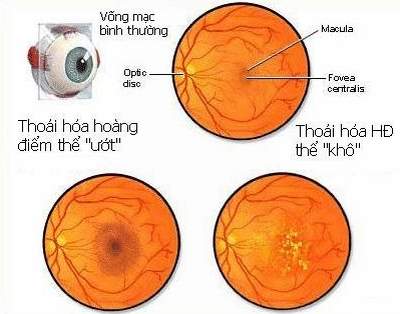 dinhduonghoc.com - Thoái hóa điểm vàng ướt, bệnh mắt mãn tính