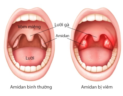 dinhduonghoc.com - Viêm amidan là gì?