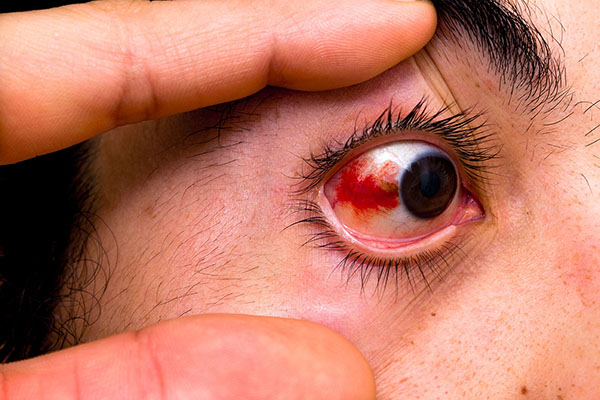 dinhduonghoc.com - Vỡ mạch máu trong mắt (subconjunctival xuất huyết)