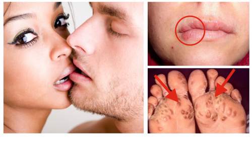 dinhduonghoc.com - Bệnh Chlamydia là gì? Cách phòng chống và điều trị