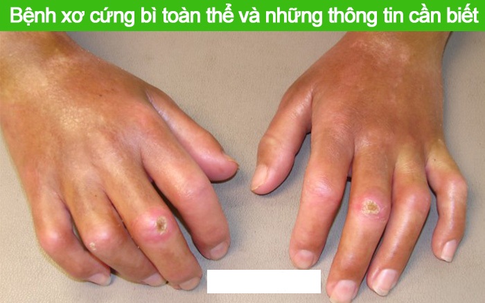dinhduonghoc.com - Xơ cứng bì, bệnh ảnh hưởng đến da và cơ quan nội tạng