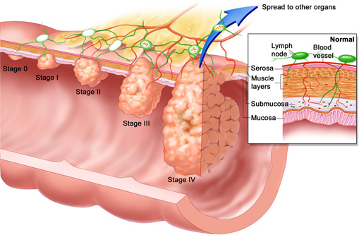dinhduonghoc.com - Bệnh polyp hậu môn là gì?