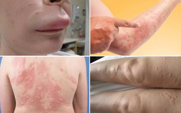 dinhduonghoc.com - Mề đay do lạnh, bệnh dị ứng với nhiệt độ lạnh