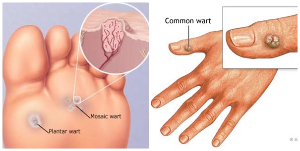 dinhduonghoc.com - Mụn cơm khô, Mụn cóc là gì?