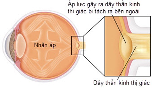 dinhduonghoc.com - Tăng nhãn áp, bệnh gây đau tức mờ mắt
